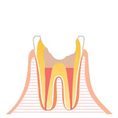 歯の空洞を 「ガッタパーチャ」という薬で埋めます。